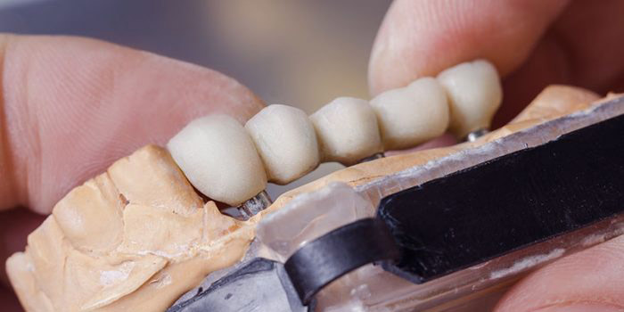 Dental bridge