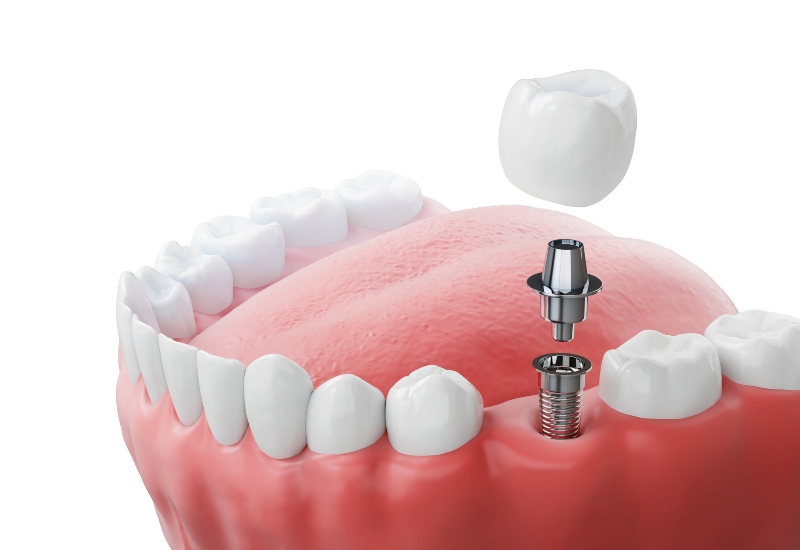 A 3D illustration of dental implant components for missing tooth replacement in Homewood, IL